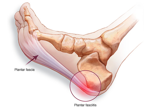 Heel Pain in Soccer Players